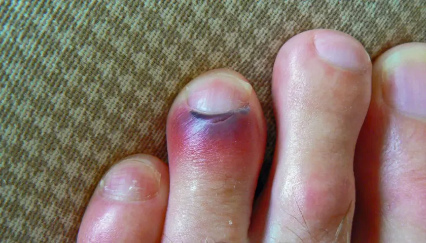 Un dedo del pie con un gran hematoma morado y rojo, indicando una lesión.