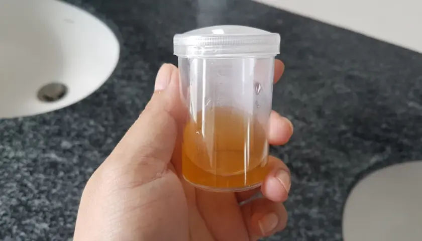 Próbka moczu z widocznymi fosforanami bezpostaciowymi.