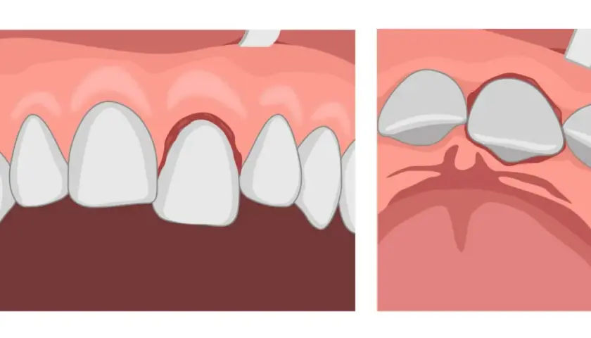 Illustrazione di gengive infiammate e denti che si allentano, suggerendo la possibilità di denti che cadono senza dolore.