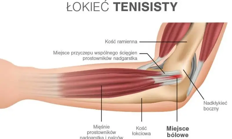 Objawy łokcia tenisisty: 7 sygnałów, których nie ignoruj