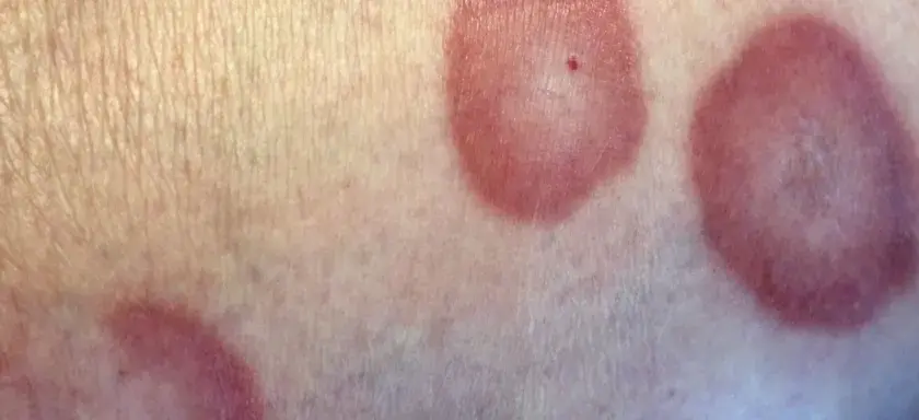 Choroba róża na nodze objawy – jak rozpoznać i uniknąć powikłań