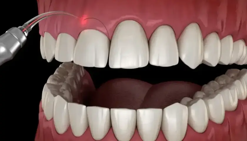 Zabieg gingiwektomii laserem. Czerwony promień lasera precyzyjnie modeluje dziąsło wokół białych zębów.