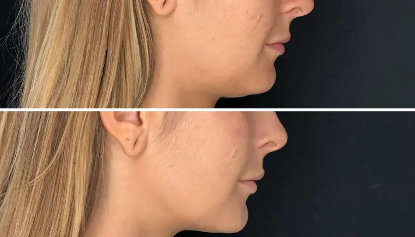 Före- och efterbilder som visar effekten av fillers i ansiktet, med en tydligare käklinje och fylligare kinder.