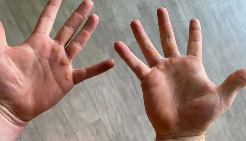 Manos con callos visibles, evidencia de trabajo duro o entrenamiento.