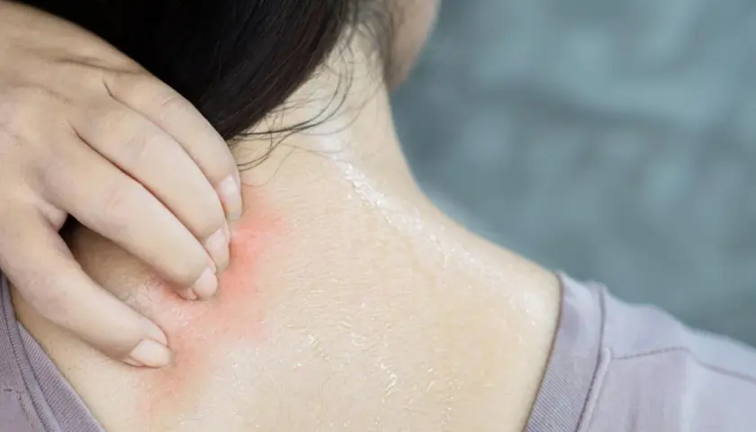 Mano che si gratta la nuca e il collo, con arrossamento e sudore. Un fastidioso prurito dietro la nuca e collo.