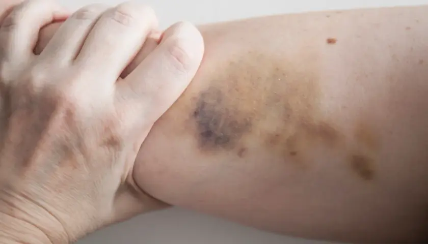 Eine Hand greift nach einem Bein mit dunklen Flecken, die auf einen Sturz oder Stoß hindeuten.