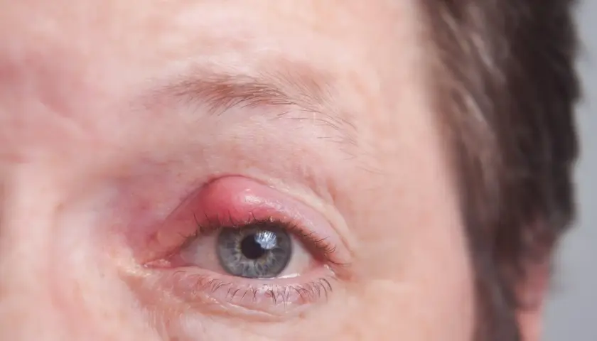 Ein roter, geschwollener Gerstenkorn am Augenlid. Dieses Gerstenkorn sieht ansteckend aus und verursacht Unbehagen.