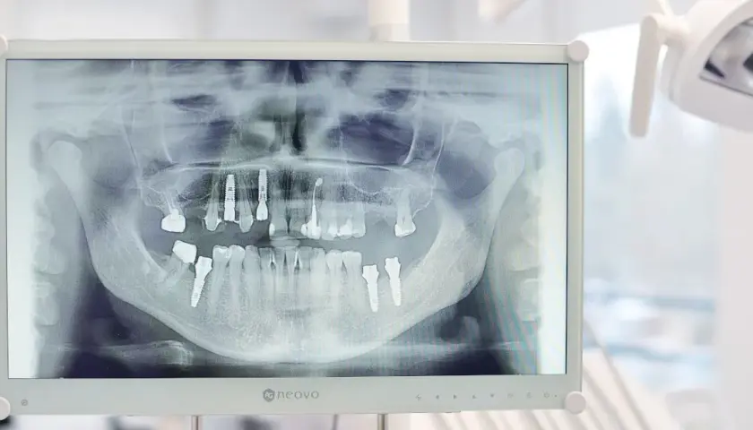 RTG zęba: Co naprawdę widzi dentysta? Ukryta próchnica i torbiele