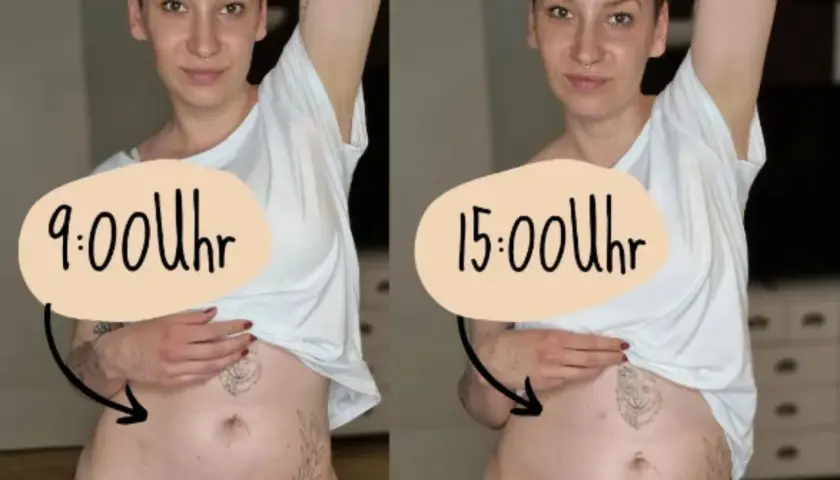 Endometrioza brzuch jak balon – przyczyny wzdęć i skuteczne metody łagodzenia