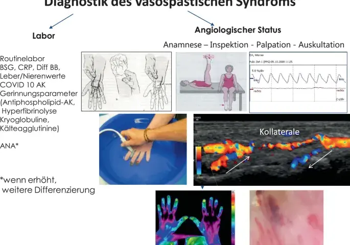 Die entscheidenden Schritte zur Diagnose des Flush-Syndroms verstehen
