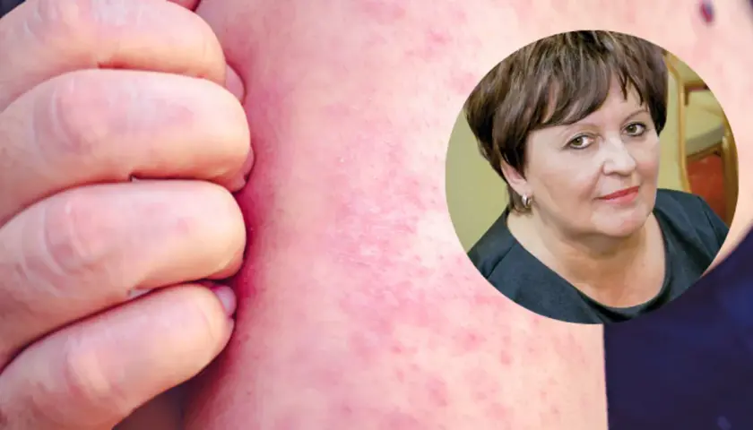 Dłoń drapiąca zaczerwienioną skórę z wysypką. W tle kobieta, być może cierpiąca na tę chorobę.