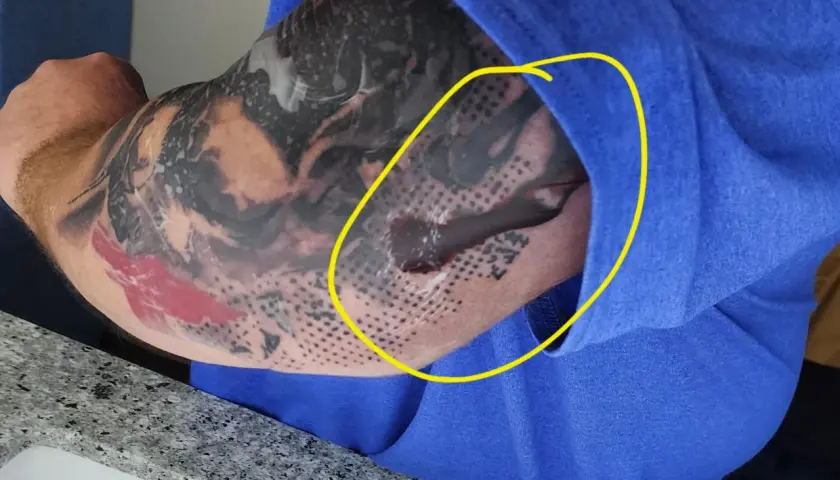 Odparzenie po second skin na ręce z tatuażem. Widoczny płyn i zaczerwienienie pod folią.