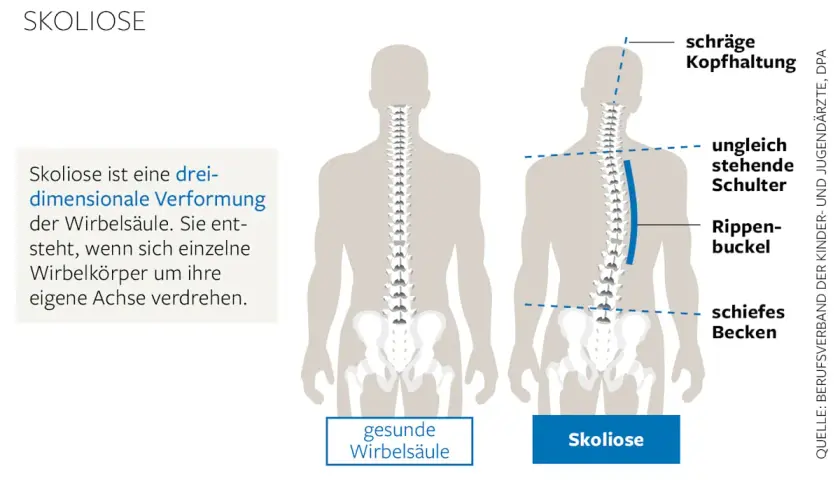 Vergleich einer gesunden Wirbelsäule mit einer Skoliose, die einen Rippenbuckel und schiefe Schultern verursacht.