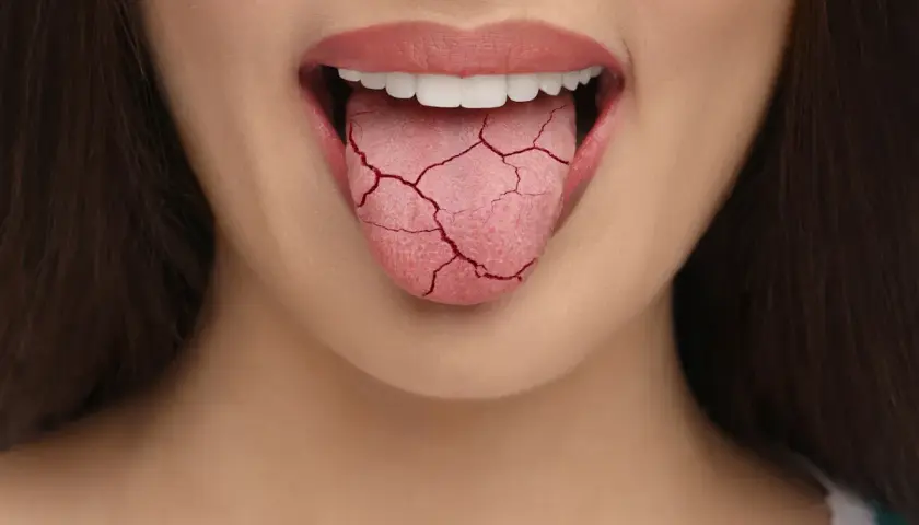 Lingua screpolata, segno di bocca secca. Cause comuni includono disidratazione, farmaci, o condizioni mediche.