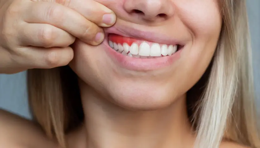 Una persona se tira del labio superior para mostrar sus encías, que están rojas e inflamadas, indicando la falta de encias sanas.