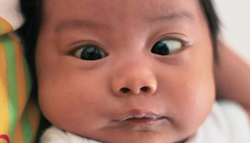 Primo piano di un neonato con strabismo. Un occhio guarda dritto, l'altro è deviato verso l'esterno.