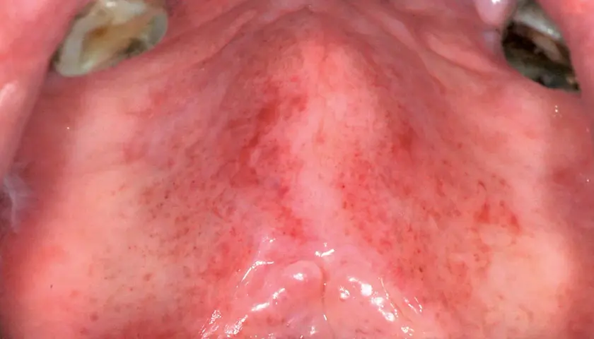 Palato con diffuse lesioni mucosa orale, petecchie rosse e aree infiammate.
