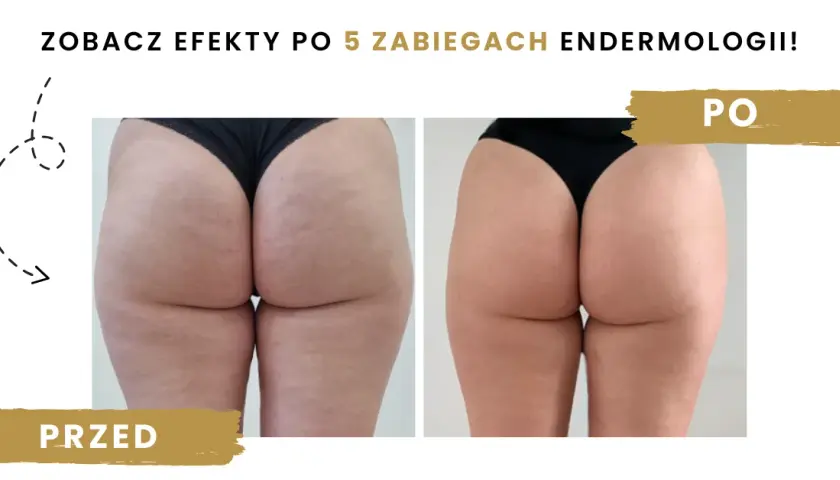 Endermologia: co to, jak działa i czy warto? Pełny przewodnik