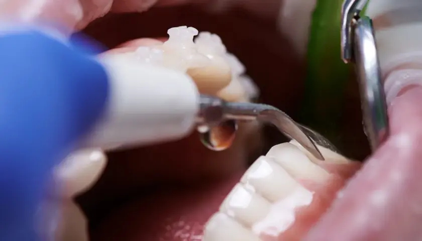 Dettaglio di una pulizia denti professionale con strumento odontoiatrico.