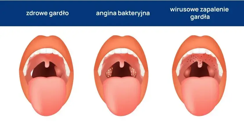 Jak złagodzić ból gardła przy anginie – skuteczne metody i porady