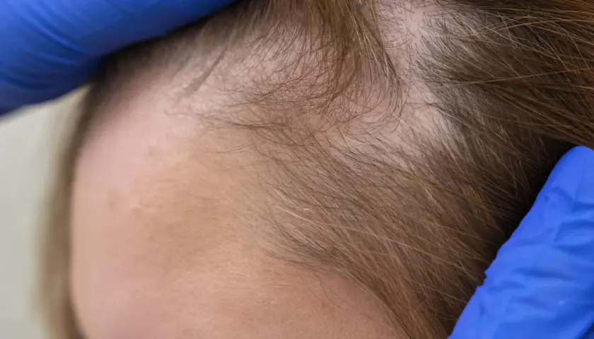 Manos enguantadas revisan la línea del cabello, mostrando una zona con menos densidad. Se investigan soluciones como el colágeno para el pelo.