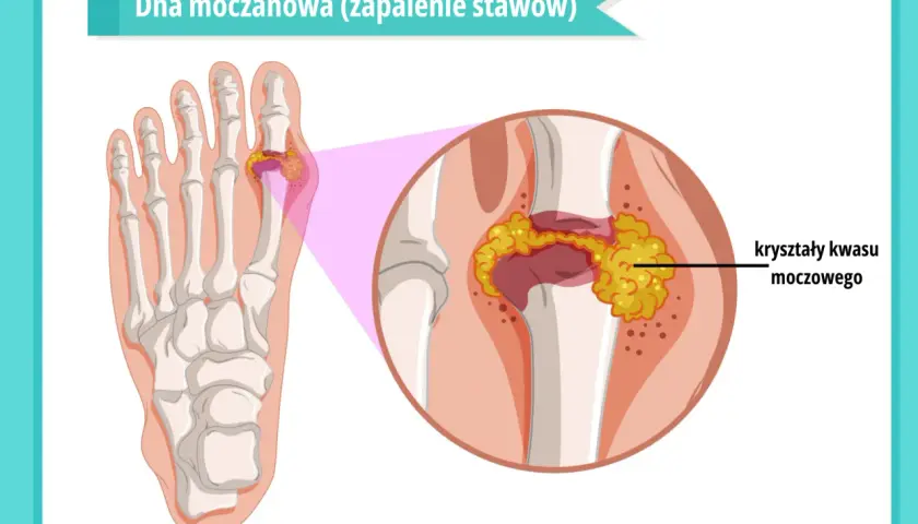 Dna moczanowa: zapalenie stawu palucha z kryształami kwasu moczowego. Jakie badania pomogą zdiagnozować problem?