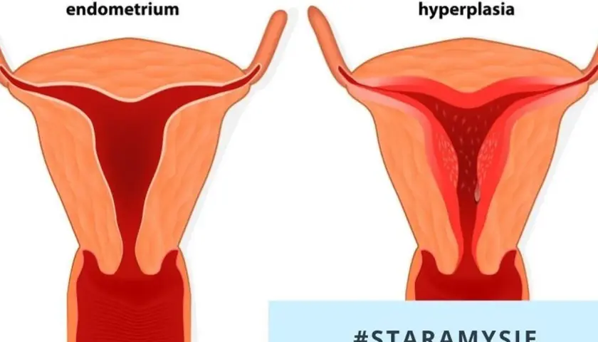 Przewlekłe zapalenie endometrium: objawy i metody leczenia.