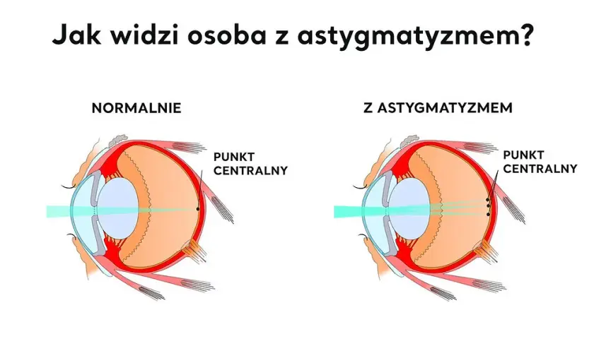 Cylindry w soczewkach: co to jest i jak wpływają na wzrok?