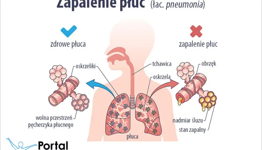 7 najgroźniejszych objawów zapalenia płuc, które musisz rozpoznać szybko