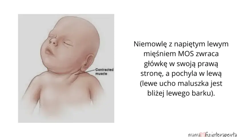 Rozpoznaj naciągnięcie mięśni karku u niemowlaka: najważniejsze objawy