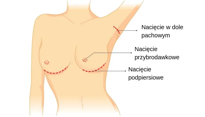 Gdzie zrobić operację biustu? Znajdź najlepsze kliniki w Polsce