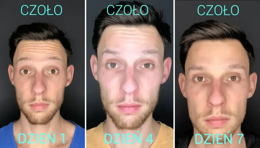 Botoks na lwia zmarszczkę: efekty i czas oczekiwania na rezultaty