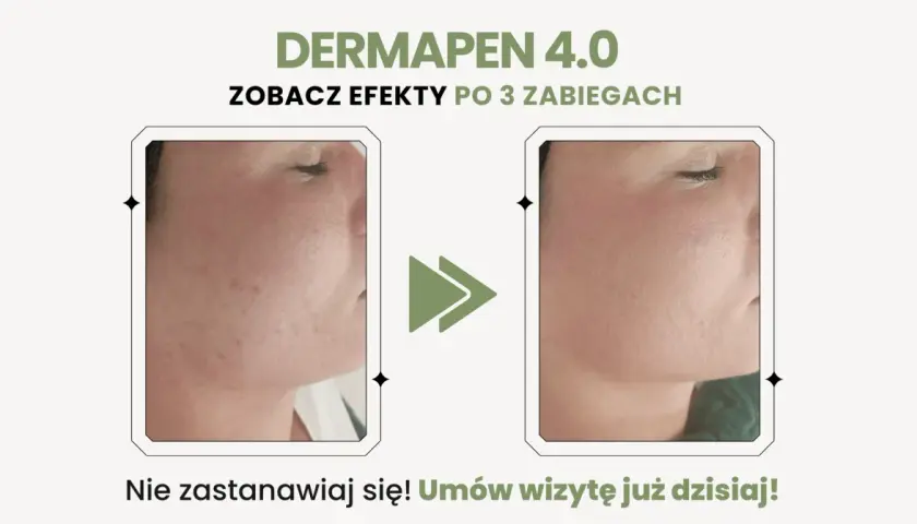 Przed i po zabiegu Dermapen 4.0: widoczne dermapen efekty po 3 zabiegach, skóra wygładzona, bez niedoskonałości.