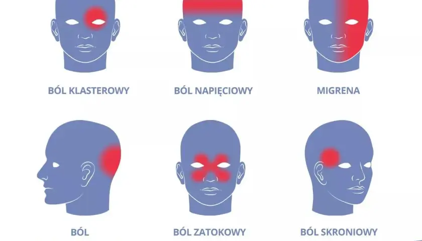 Ilustracja pokazuje lokalizację bólu głowy: klasterowego, napięciowego, migreny, szyjnopochodnego, zatokowego i skroniowego.