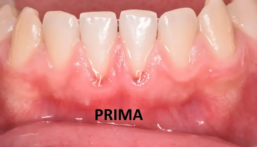Gengive infiammate e arrossate intorno ai denti anteriori, con segni di recessione gengivale. La parola "PRIMA" indica la situazione iniziale.
