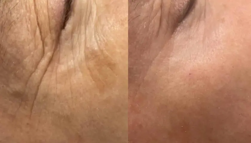 Split image showing before and after of skin treated with fractional CO2 laser, with reduced wrinkles.