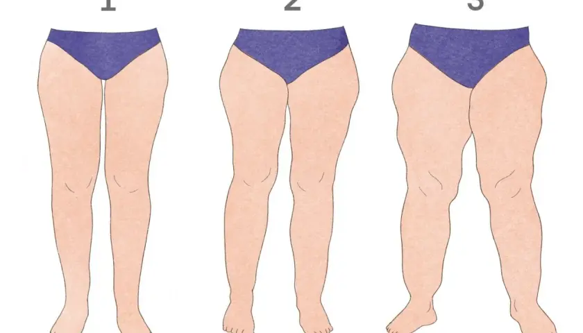 Ilustracja pokazuje trzy pary nóg, od szczupłych do z wyraźnym nagromadzeniem tkanki tłuszczowej, ilustrując stopnie lipodemia u szczupłych osób.