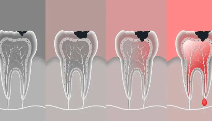 Ilustración muestra cómo es una caries dental, desde una pequeña mancha negra hasta una infección avanzada con pus.