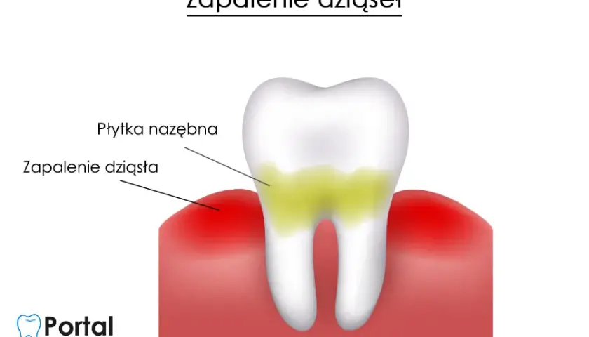 Zapalenie dziąseł? Jak skutecznie leczyć w domu i u dentysty