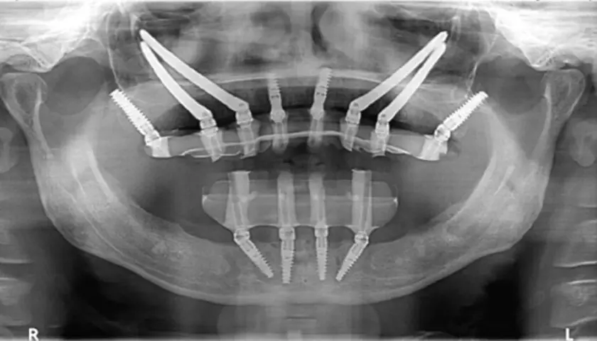 Radiografia panoramica mostra impianti dentali posizionati in arcate mascellari con ridotta quantità di osso, una soluzione per chi necessita di impianti dentali senza osso.