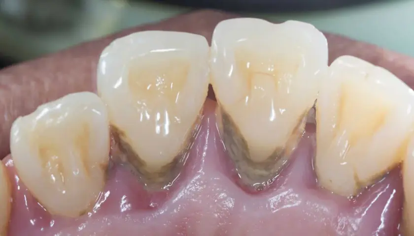 Denti con evidente accumulo di tartaro e infiammazione gengivale, segni di paradontosi dentale.