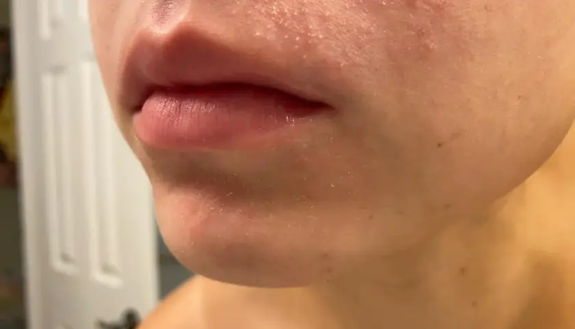 Närbild på mun och haka med rodnad och små utslag, tecken på elidel perioral dermatit.