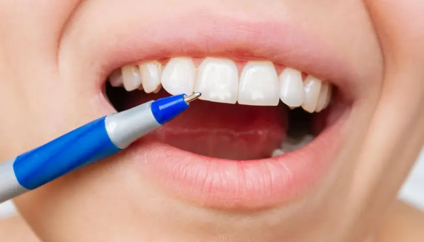 Applicazione di fluoro sui denti con una penna speciale per una protezione duratura.