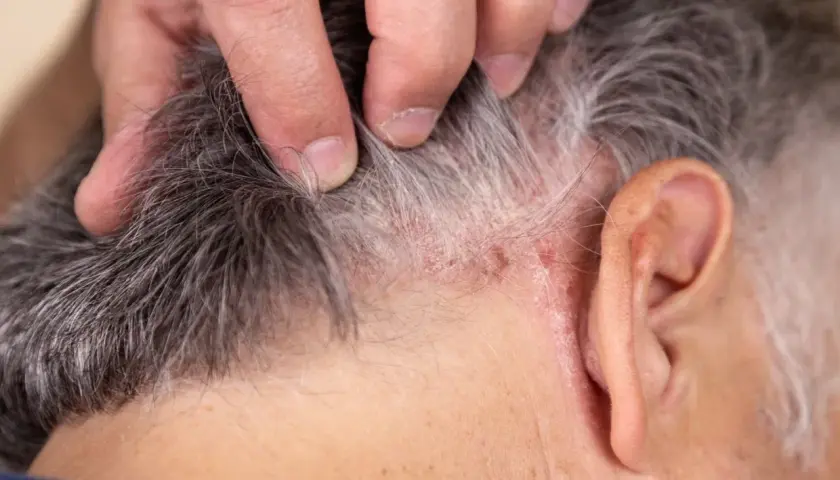 Dedos separan cabello gris mostrando escamas y enrojecimiento, indicando posible tiña en el pelo.