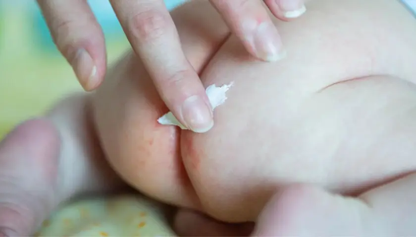 Mano applica crema su piaghe culetto neonato. Come curarla con delicatezza per lenire il rossore.