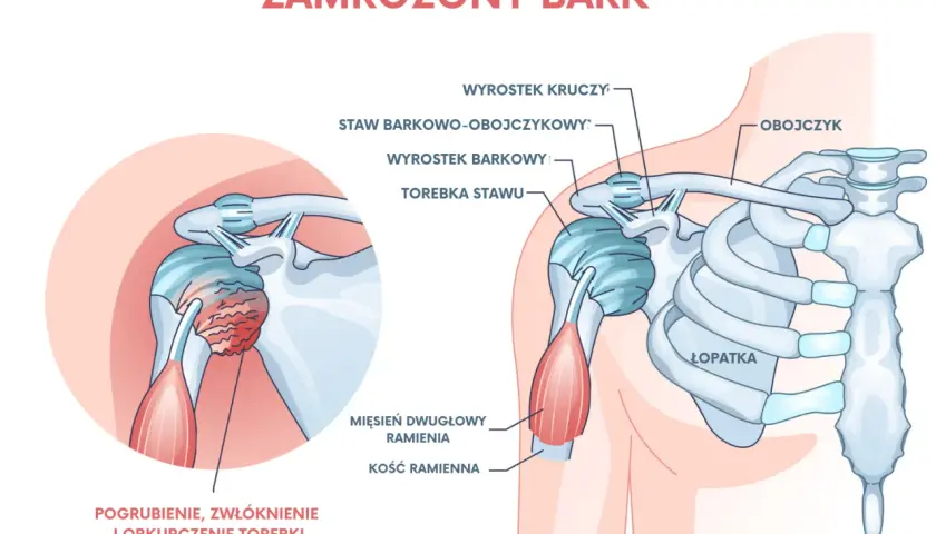 Zamrożony bark: pogrubienie, zwłóknienie i obkurczenie torebki stawu ramiennego wyjaśnia, dlaczego bolą ramiona.