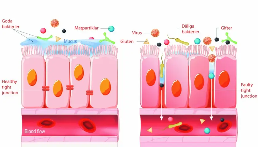 Illustration visar en frisk tarm med täta cellförbindelser och en läckande tarm där dåliga bakterier, virus och gifter passerar in i blodflödet, vilket orsakar inflammation.
