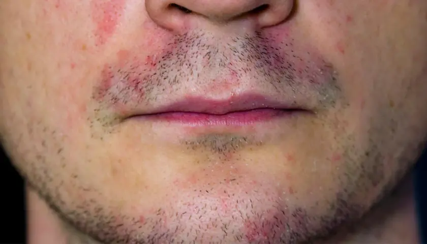 Trockene, schuppige Gesichtshaut? Ursachen, Soforthilfe & Pflegetipps