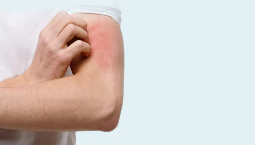 Un bras rouge et irrité se gratte, une sensation de chatouillement sur la peau qui devient insupportable.