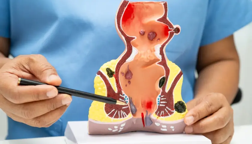 Modello anatomico che illustra emorroidi sanguinanti e altre patologie anali.